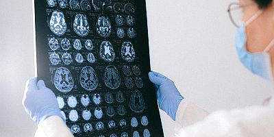 Alzheimer’de En Yaygın Belirti: Kısa Süreli Hafıza Kaybı