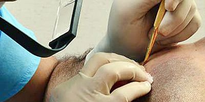 Sahte saç ekim uzmanına 3 yıl hapis